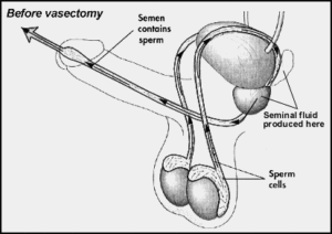 Vasectomy in Dallas Fort Worth