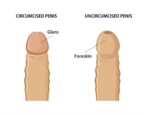 too much foreskin remaining after circumcision can result in penile skin bridge