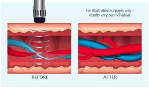 Soundwave therapy for ED
